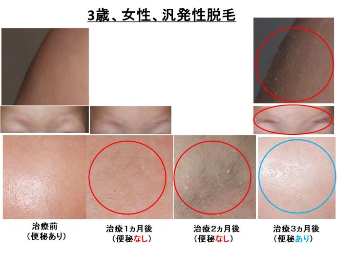 円形脱毛症　病院